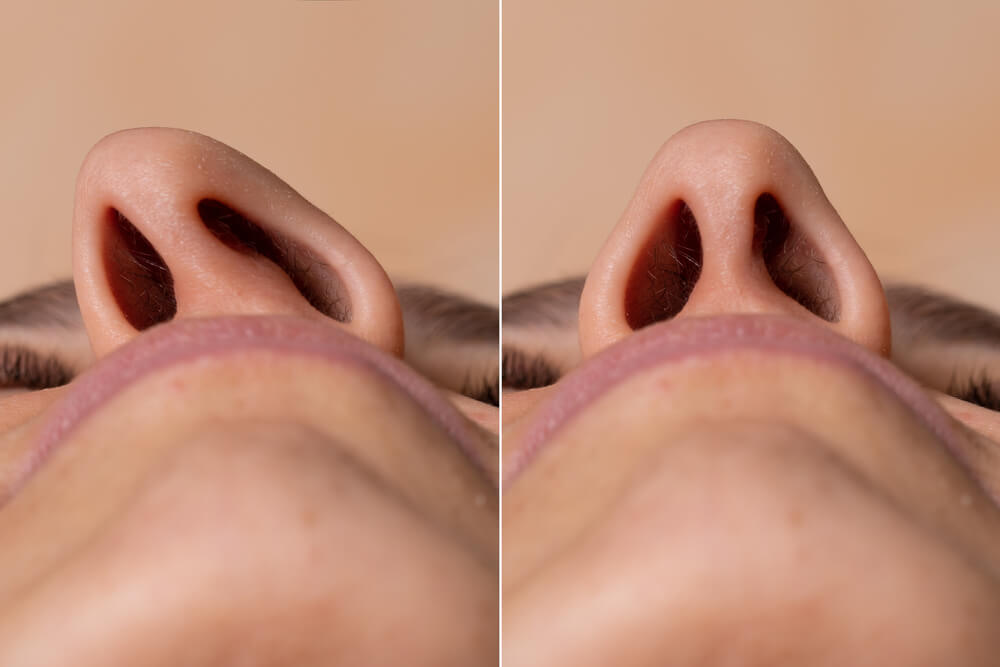Before and after a rhinoplasty to correct the deviated nasal septum