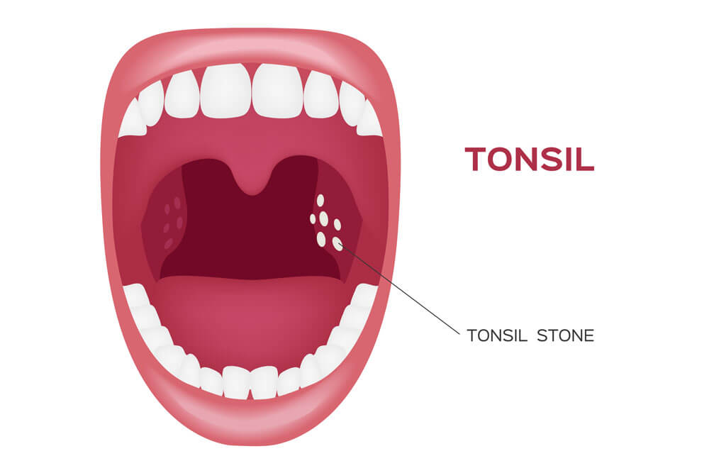 tonsil stone in the mouth vector