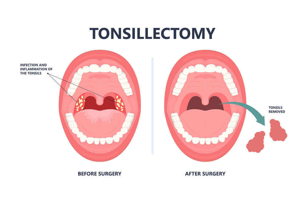 Tonsil Stones crypts viral virus gland strep throat sore enlarged lymph nodes neck pain swollen pus white mouth