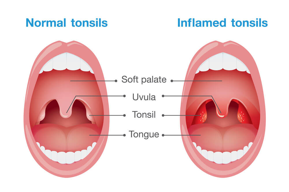 Comparison between normal tonsils and inflamed tonsils. This illustration about health care and medical.